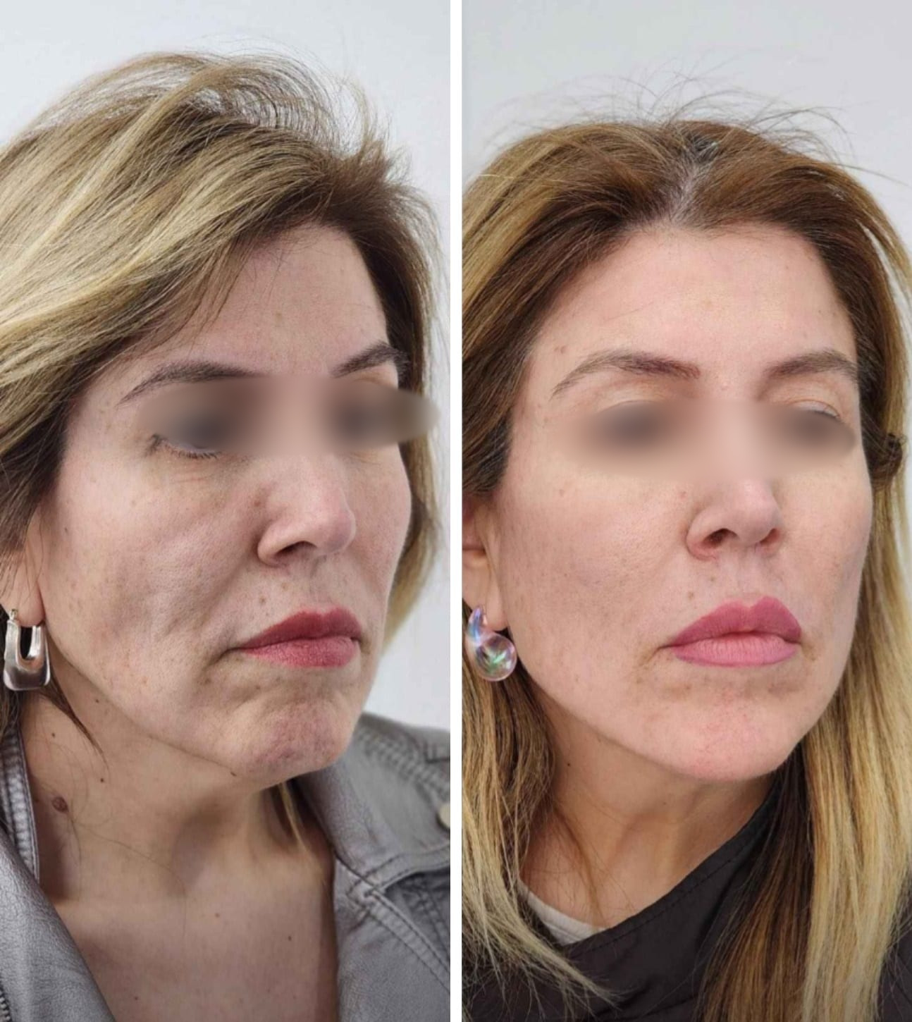 Lifting Facial y Cuello caso 7 — antes y después